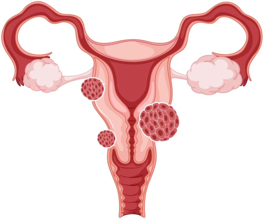 Uterus with Fibroids_mobile Uterus with Fibroids_mobile