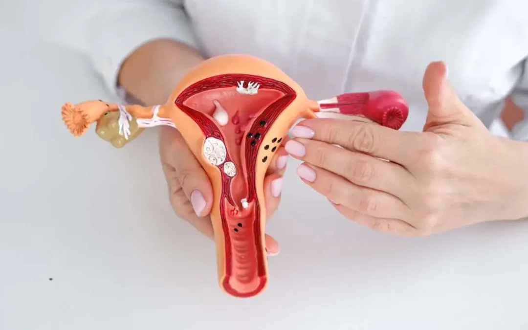Uterine Fibroid Treatments Explained: Why More Women Are Choosing UFE