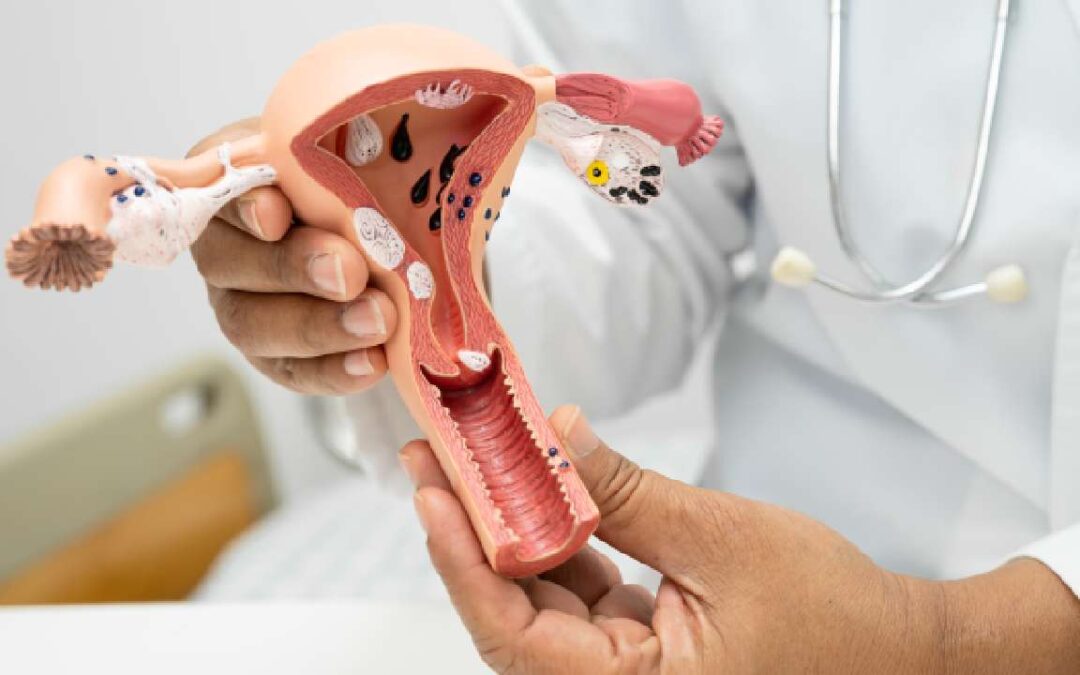 What Is the ICD-10 Code for Uterine Fibroids?