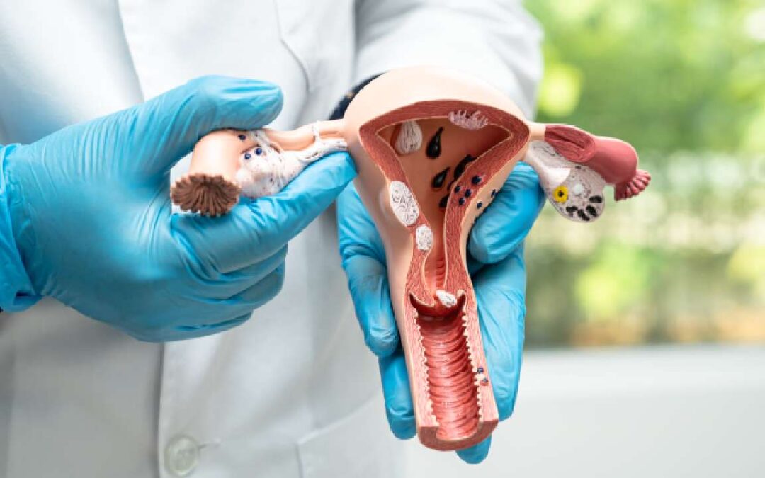 Recommendations to Identify If You Have Uterine Fibroids