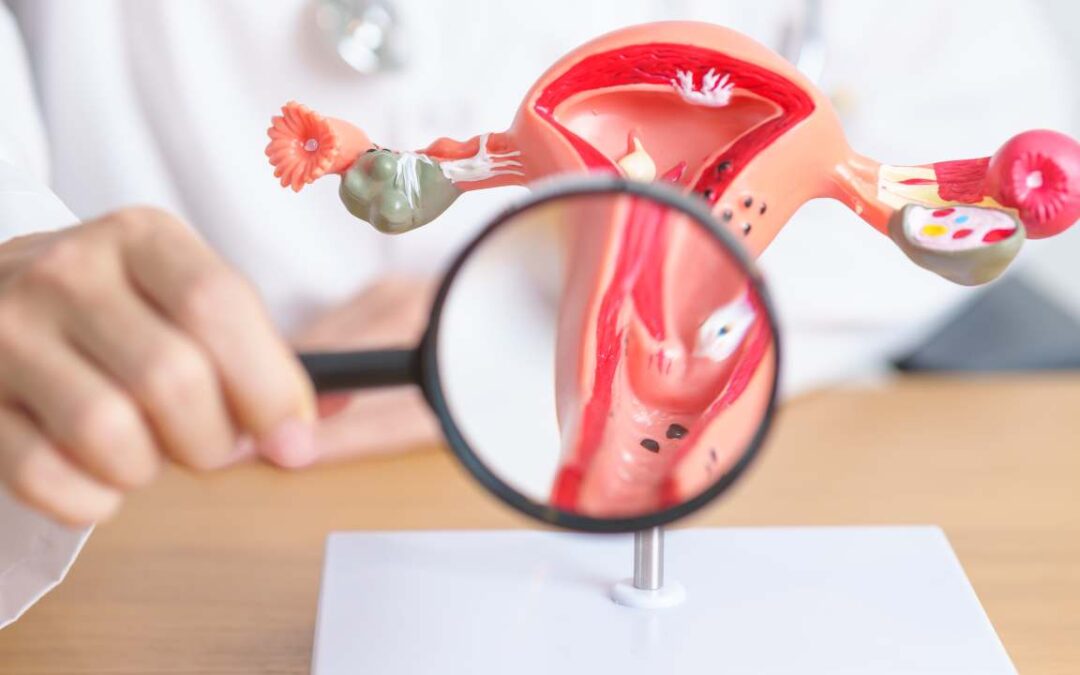 What Happens When Fibroids Grow Outside the Uterus?