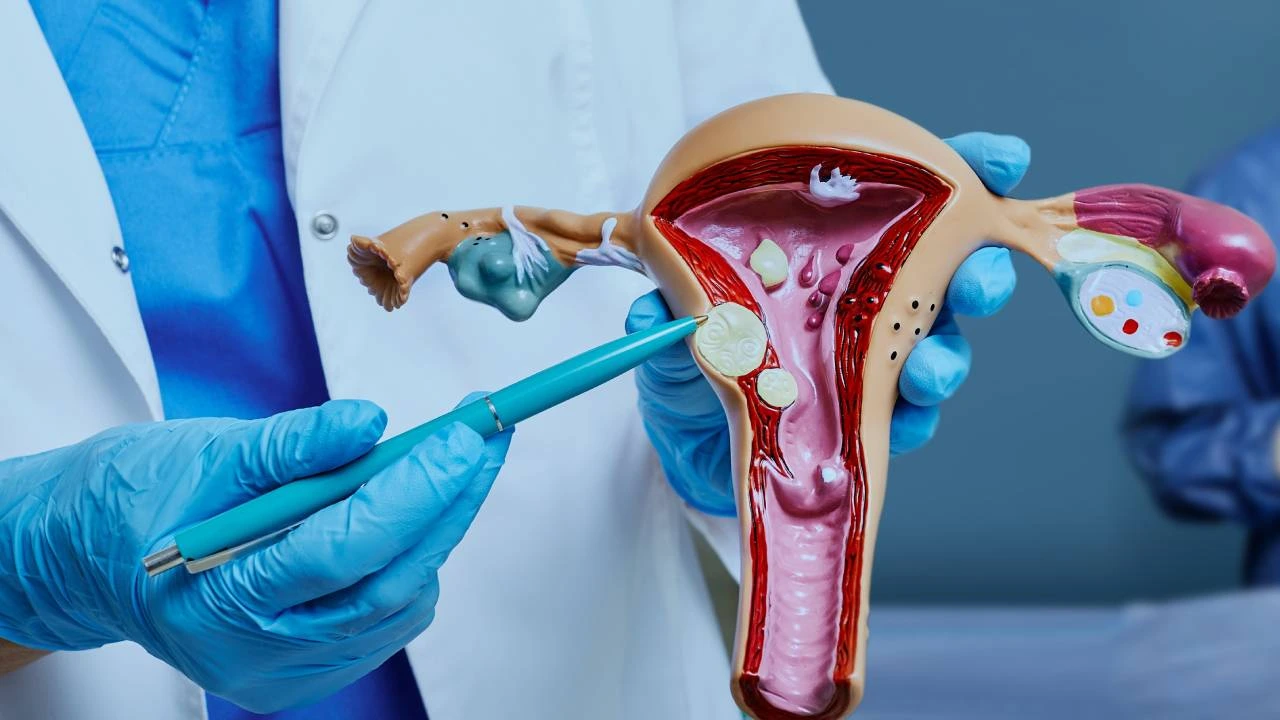 does fibroid removal affect hormones?